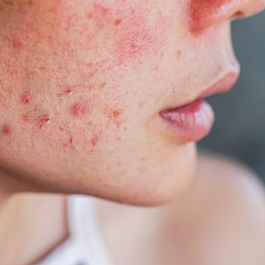 Does Adderall Cause Acne? What Is Reality?